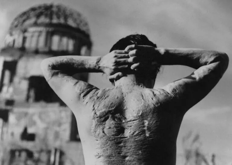 'Lucky' survivors of Hiroshima and Nagasaki bombs suffered severe burns